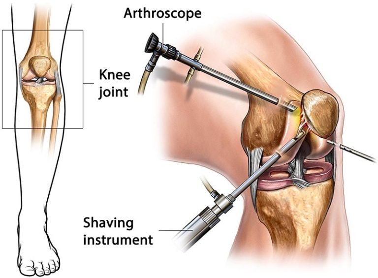 Arthroscopy Illustration